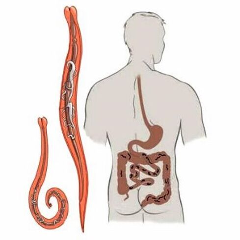 worms in human intestines
