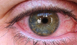 the reasons for the appearance of parasites in the eyes of humans